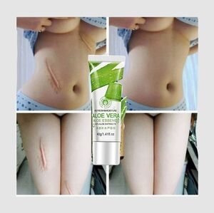 MarksRemoval Cream Burns CutsStretch Marks Treatment Cream